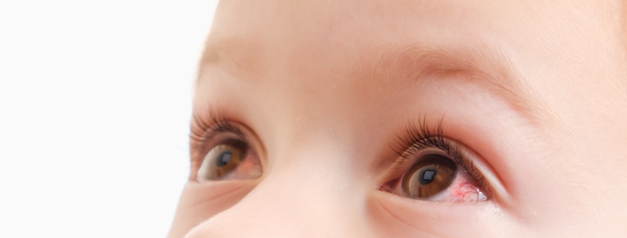 Why Does Your Baby Have Red Eyes? A Parents' Guide